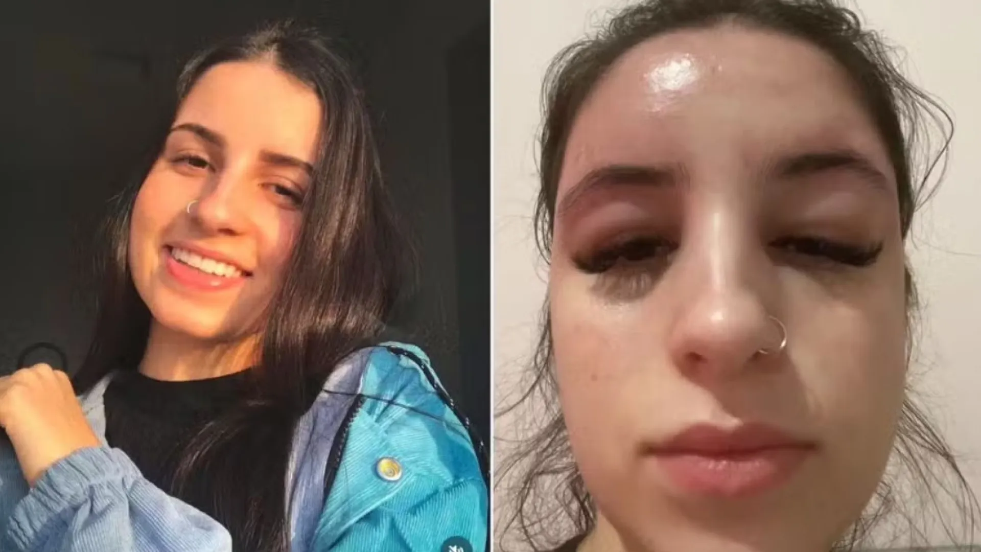 'Espremi duas espinhas e tive uma infecção das bactérias das unhas' - img