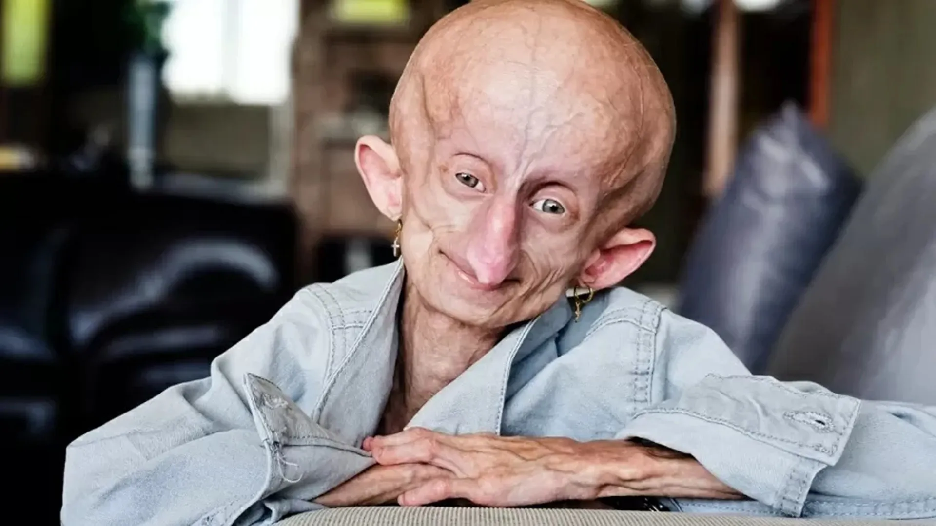 Morre Beandri Booysen, influenciadora de 19 anos com doença rara - img