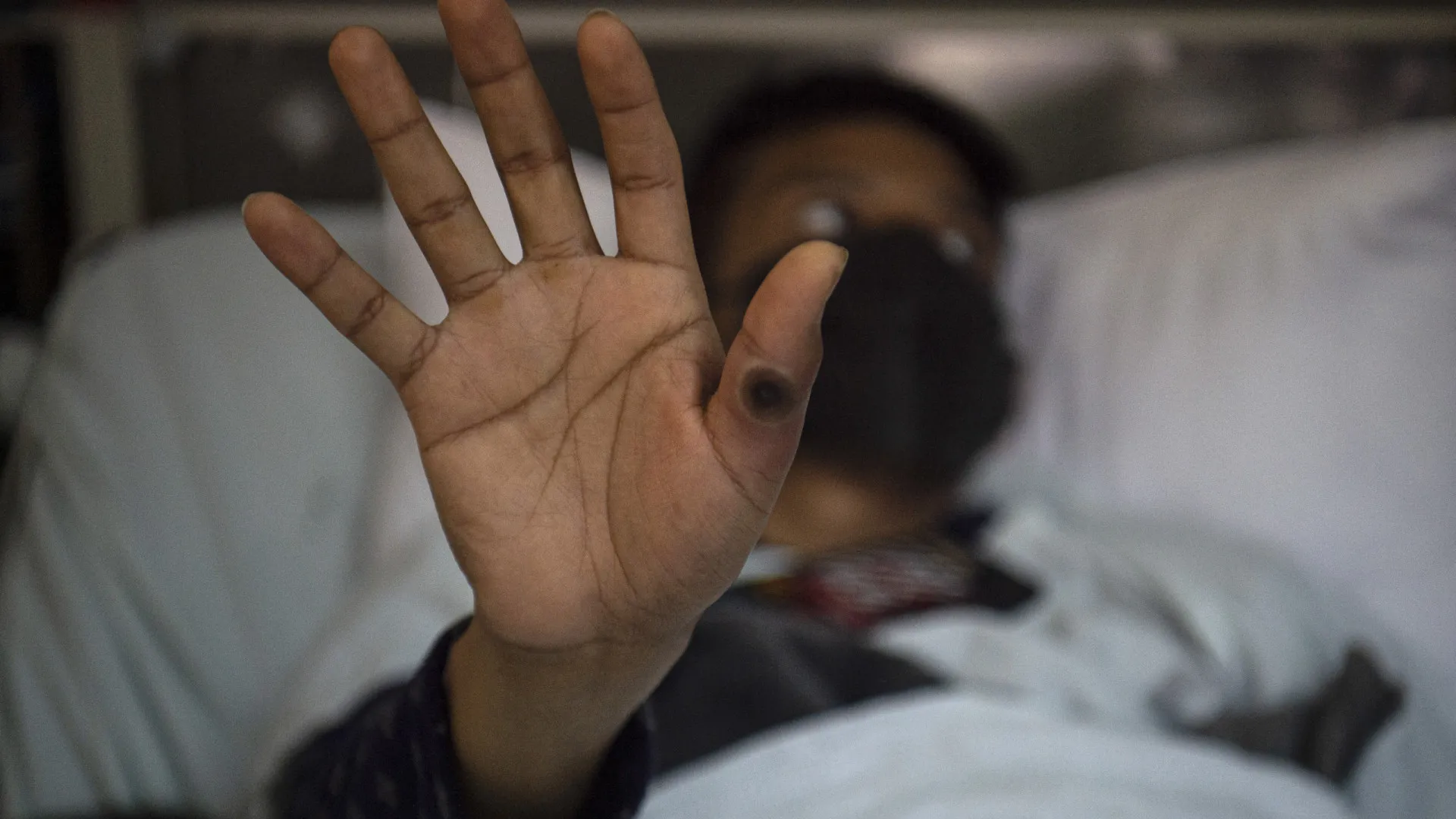 O que se sabe sobre a nova variante de Mpox identificada no Brasil - img