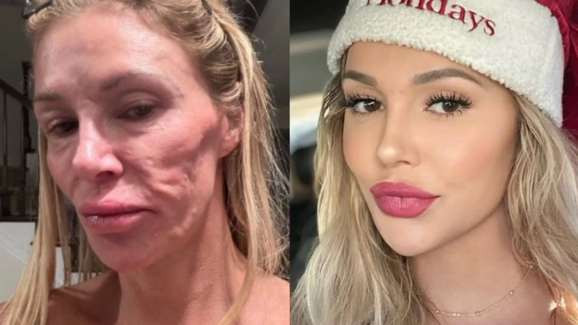 Ex-modelo que teve rosto derretido revela que perdeu 5 dentes - img