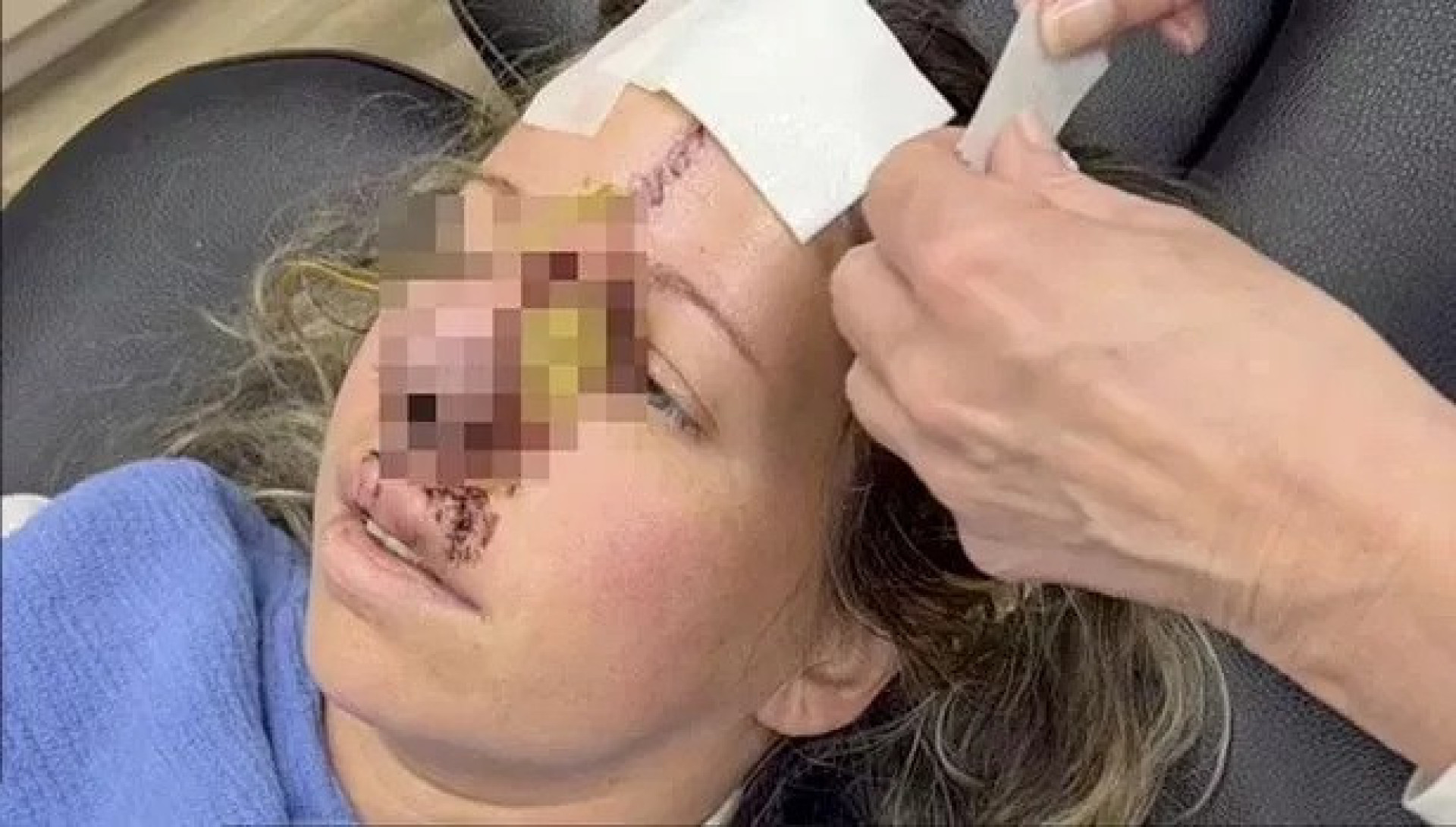 Mulher é atacada pelo próprio cão e tem nariz arrancado nos EUA - img