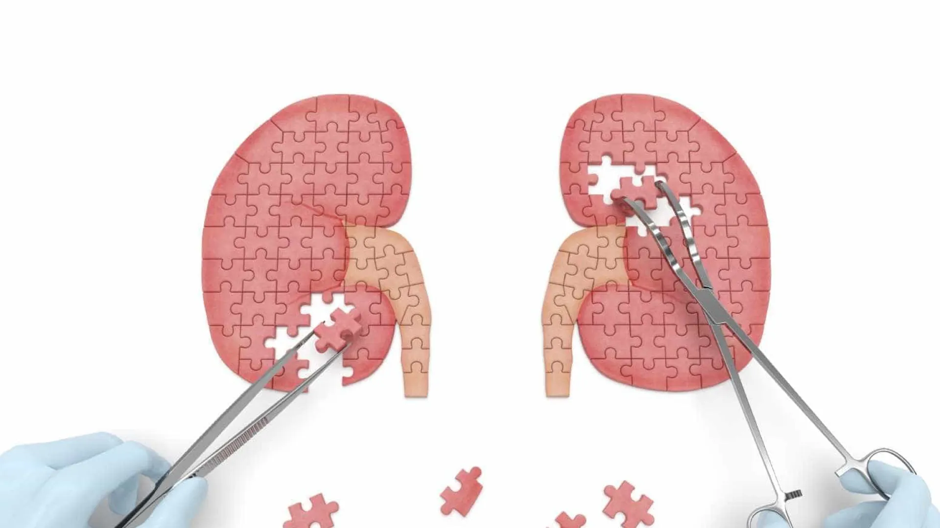 Pedras nos rins podem levar à doença renal crônica? - img