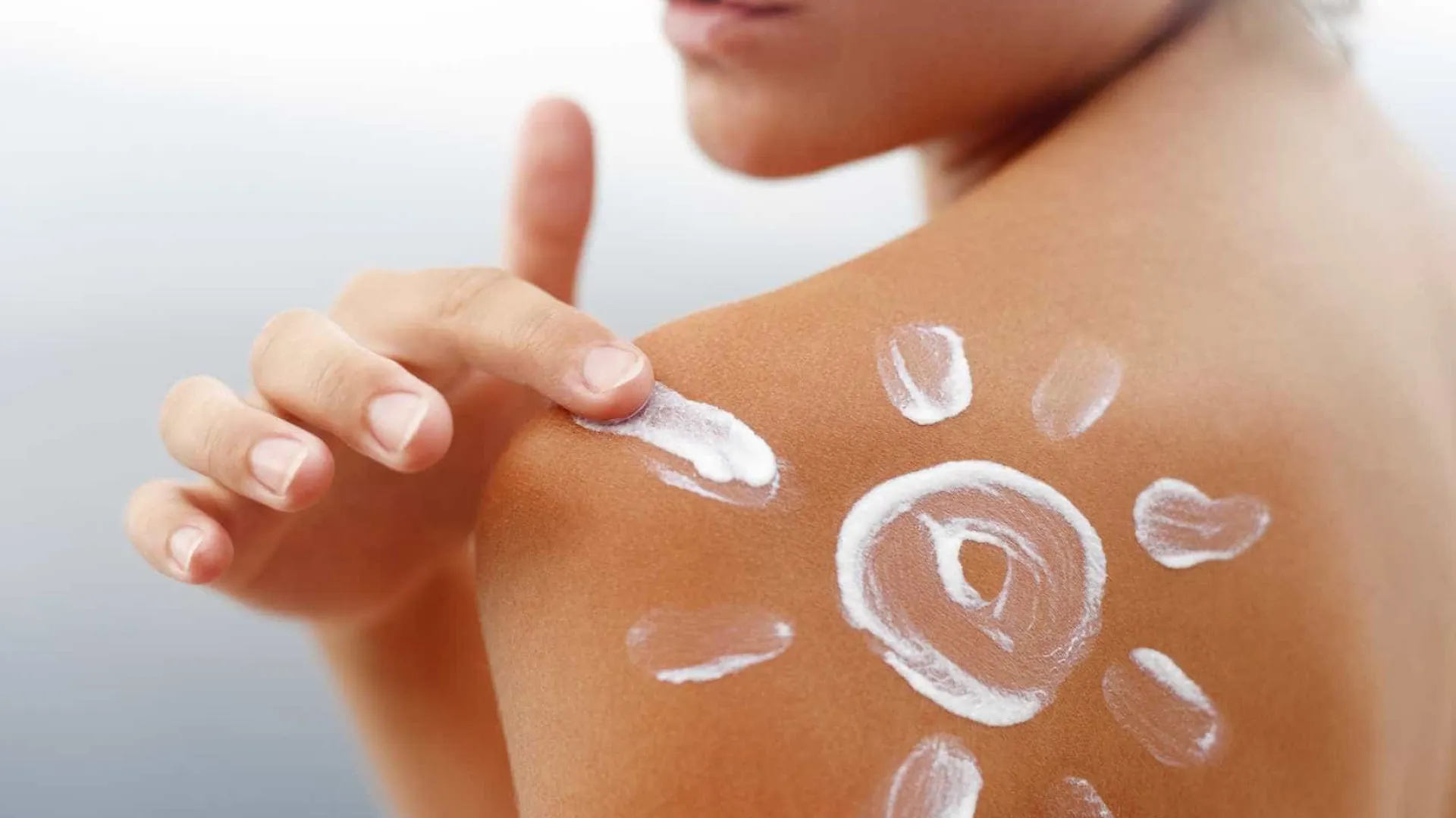 Verão: Esqueceu o protetor? O que fazer em casos de queimaduras solares - img