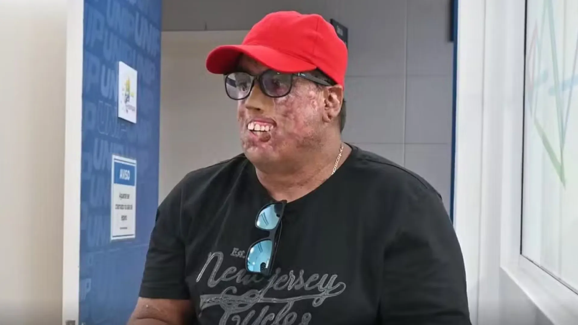 Homem com doença rara passa por 230 cirurgias no rosto e ganha prótese - img