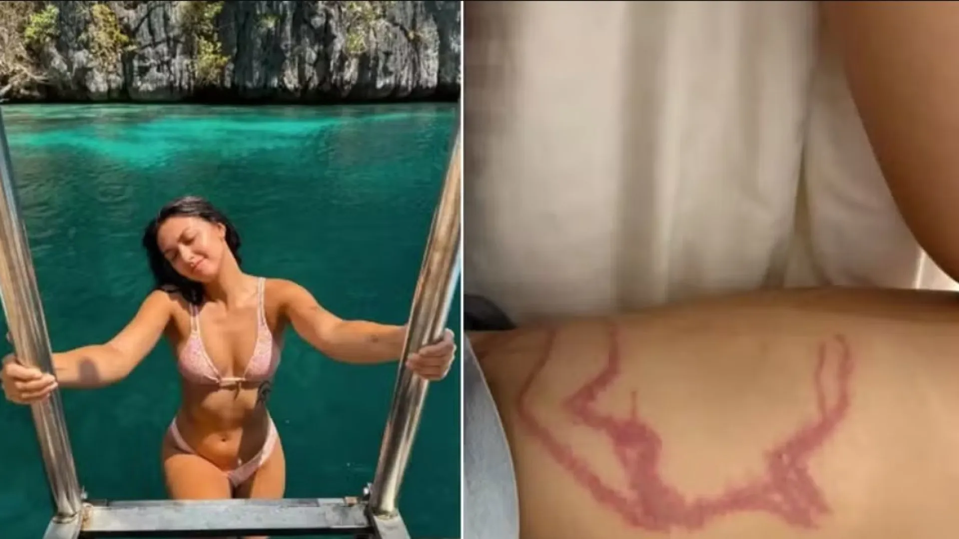 Influencer é picada por espécie de água-viva "mais venenosas" do mundo - img