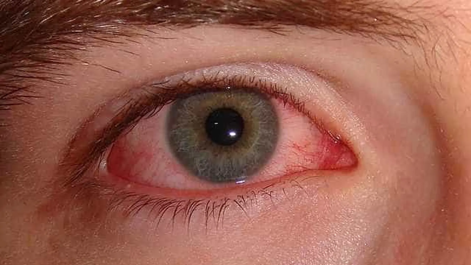 Gripe e resfriado aumentam casos de conjuntivite - img