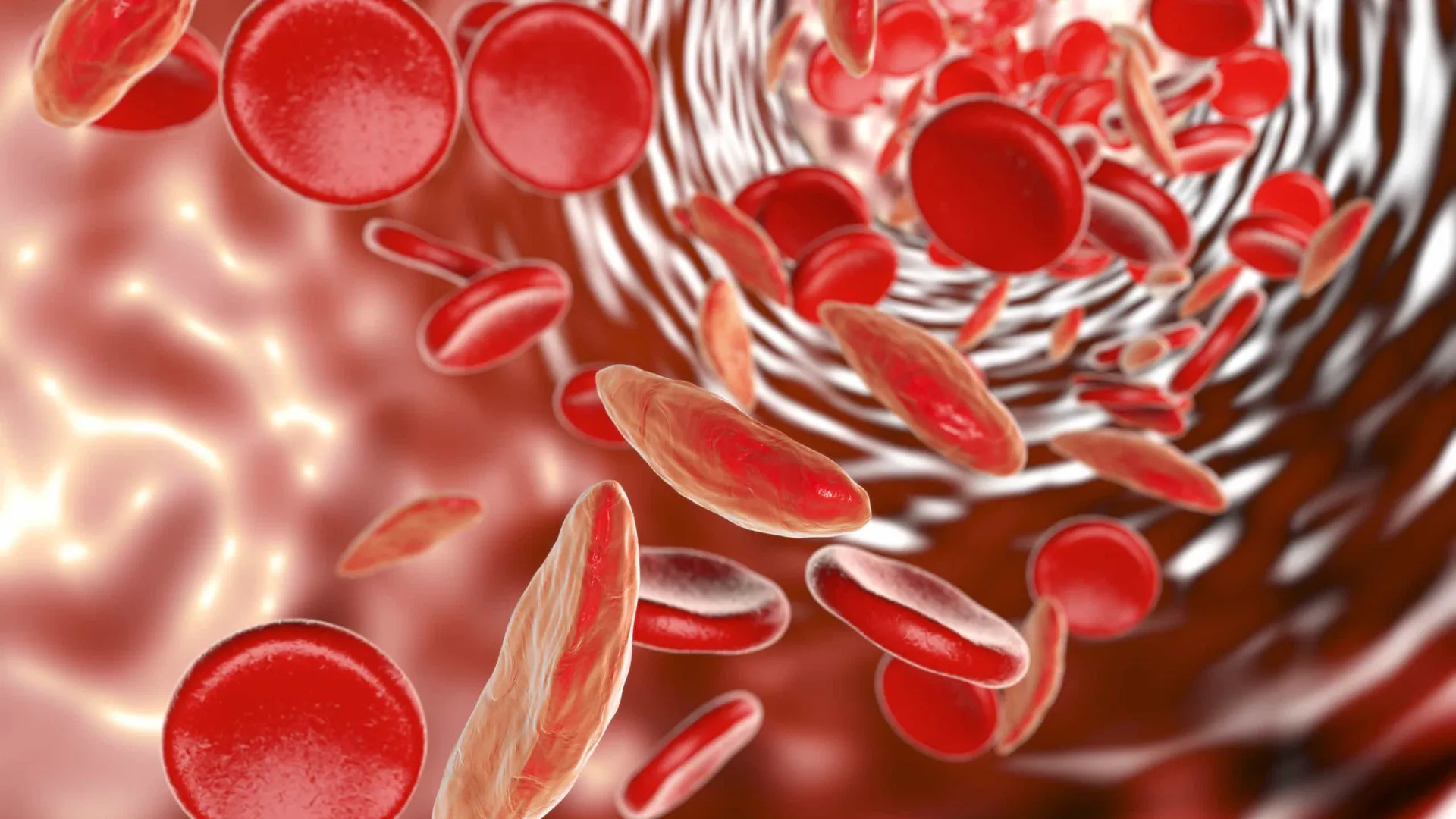 Sabe o que é anemia falciforme ou drepanocitose? Saiba os sintomas - img