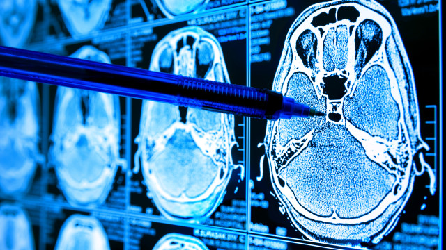 Médico fala 11 hábitos que podem reduzir pela metade o risco de Alzheimer - img