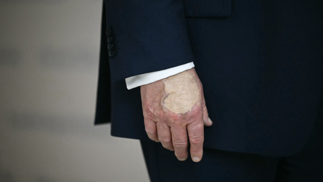 Após maquiagem, Trump surge com grande mancha roxa na mão; veja! - img