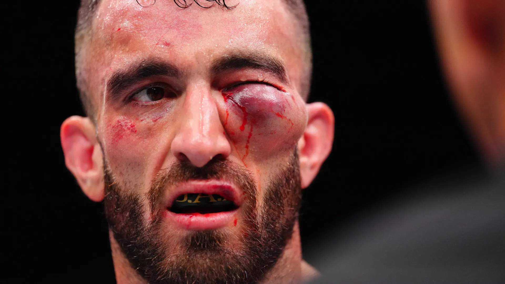 Lutador perde no UFC e tem rosto desfigurado; imagem é forte - img