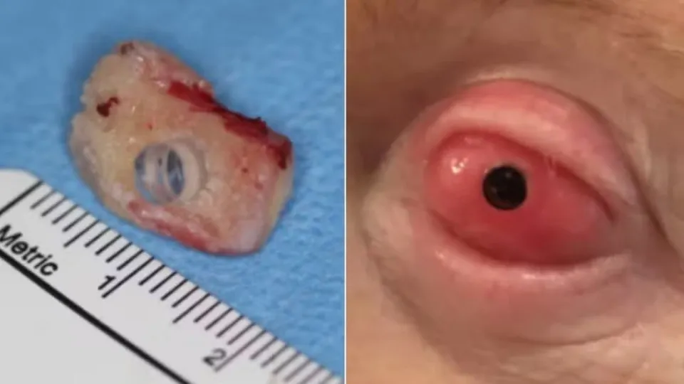 Paciente volta a enxergar após ter dente implantado no olho - img