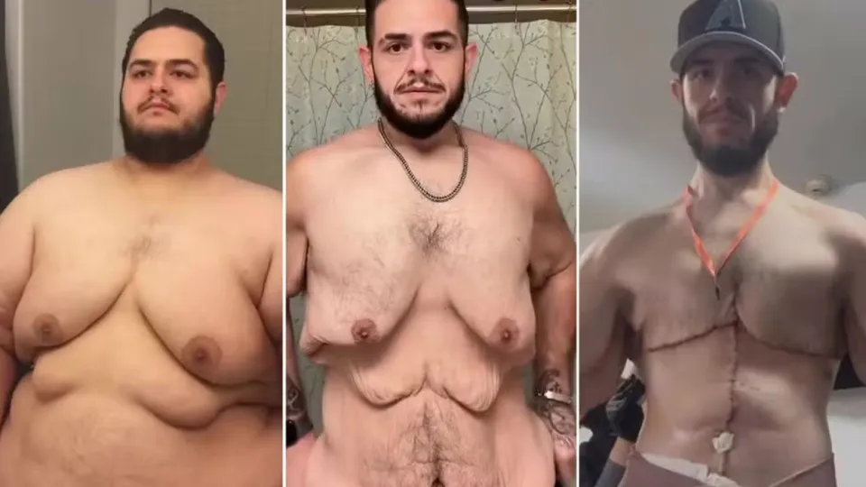 Antes e Depois: Influencer perde 150 kg e retira 7 kg de excesso de pele - img
