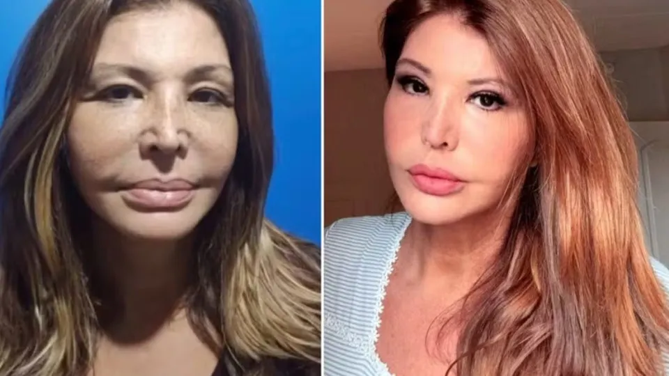 Lembra dela? Musa dos anos 90 recorre à harmonização facial - img