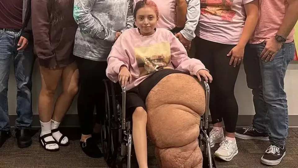 Garota de 14 anos passa por cirurgia de 17h para remover a perna de 79kg - img