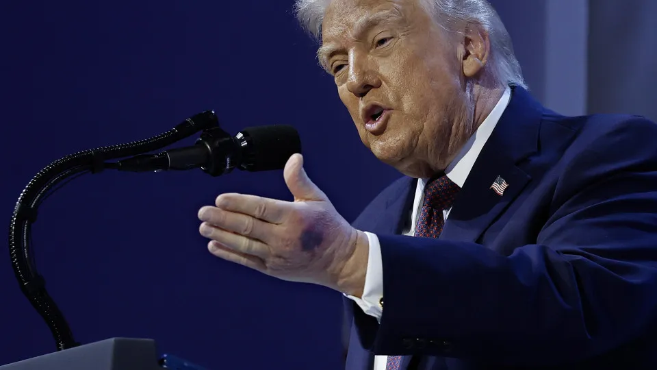 Aspirina, hematomas e saúde "perfeita": Manchas em Trump chamam atenção - img