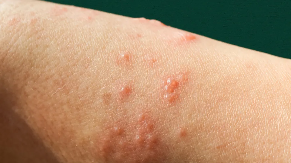Mpox: nova recombinação de cepas é identificada pela OMS - img