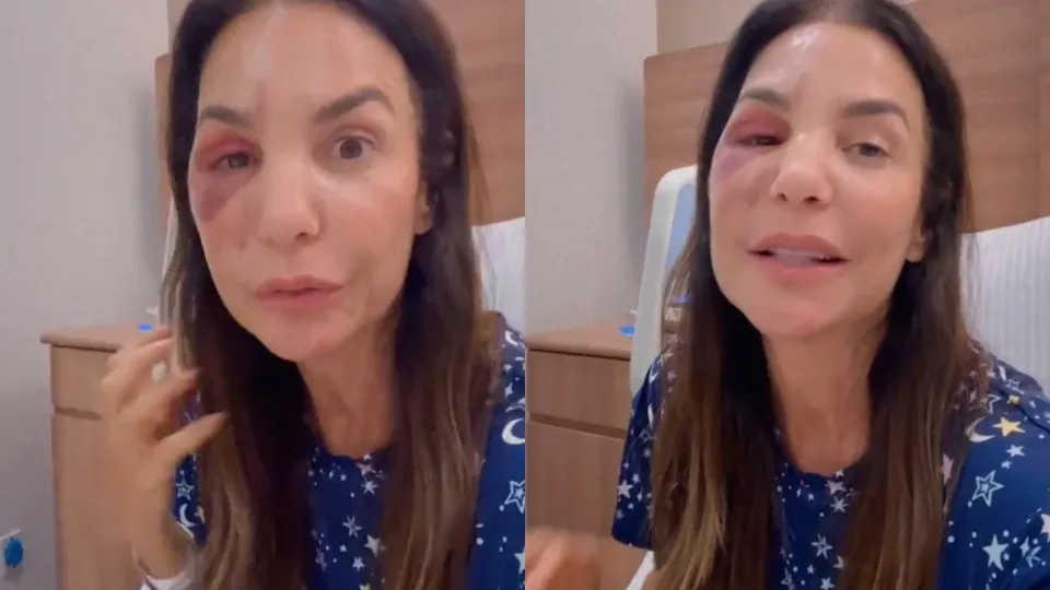 Ivete Sangalo faz cirurgia para corrigir fratura no maxilar após queda - img