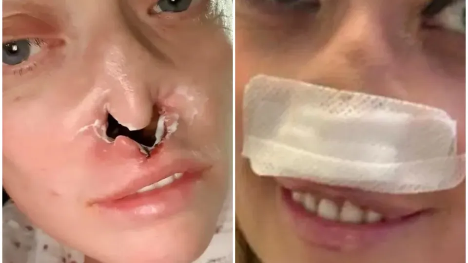 Mulher faz implante dentário e fica com ‘buraco’ no rosto: “Dói muito" - img